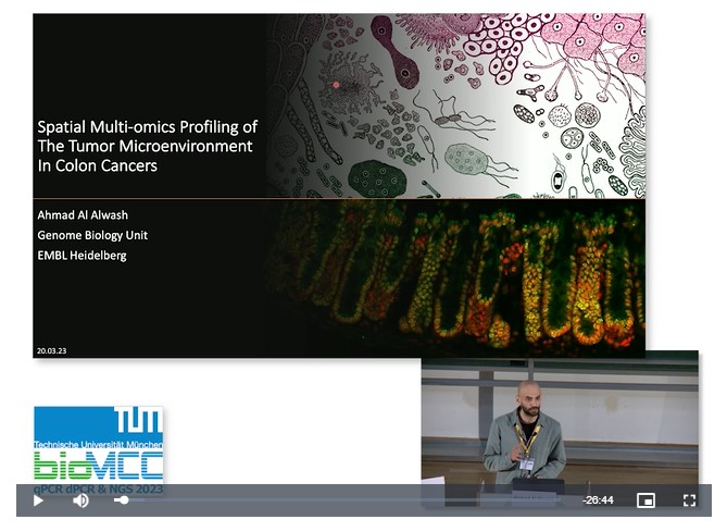 Spatial Multi-omics Analysis of The Tumor Microenvironment in Colon Cancers